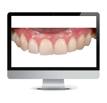 Diseño de sonrisa digital 1