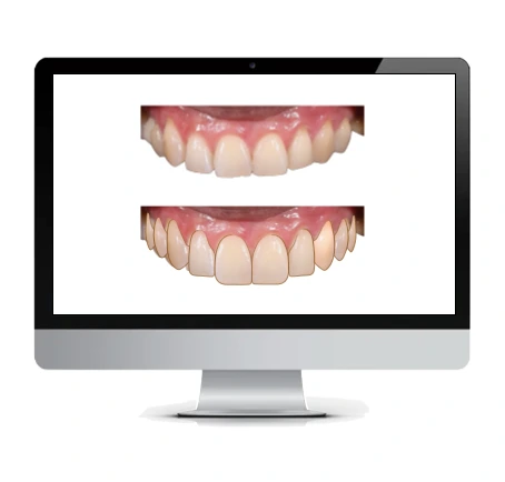 Diseño de sonrisa digital 3