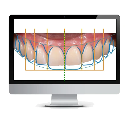 Diseño digital de sonrisa 2