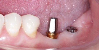 Implantes dentales colocados en clínica dental Smile & life® Aguascalientes