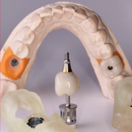 Implantes dentales colocados y rehabilitados por los mejores implantólogos dentales de Aguascalientes en clínica dental Smile & life®