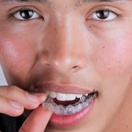 Ortodoncia con alineadores con los mejores ortodoncistas en Aguascalentes clínica dental Smile & life®