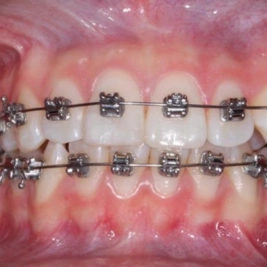 Ortodoncia con brackets