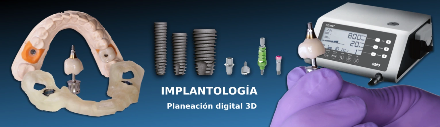Planeación digital 3D en Implantología para la rehabilitación con implantes dentales en clínica dental Smile & life® Aguascalientes