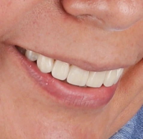 Prótesis dental de clínica dental Smile & life®
