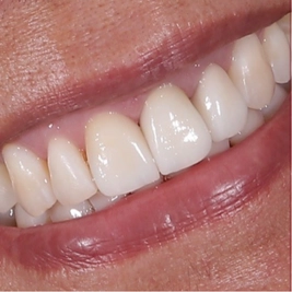 Prótesis dentales en porcelana realizada en Smile & life por los mejores dentistas en Aguascalientes