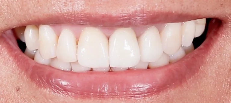 Limpieza dental perfecta Clínica dental Smile & life® Aguascalientes